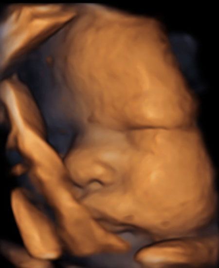 down syndrome ultrasound 4d