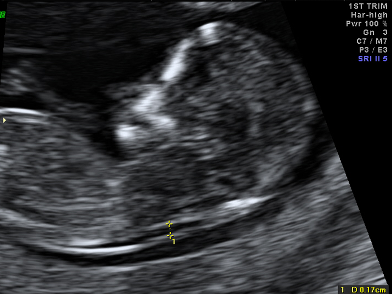 Ultrasound and Obstetrics | Newcastle Ultrasound