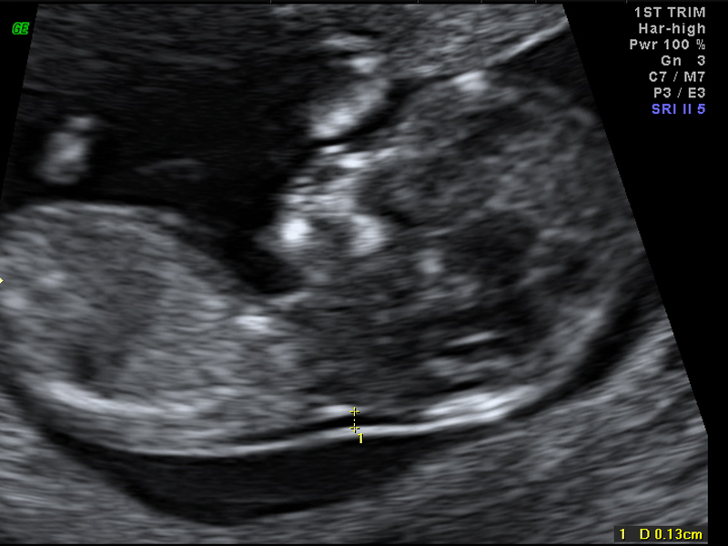 Pregnancy | Prenatal Care from Newcastle Ultrasound